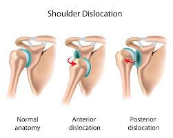 خلع الكتف (Dislocated shoulder)