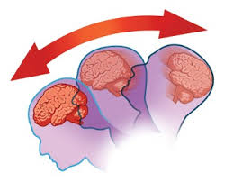 ارتجاج الدماغ (Concussion)
